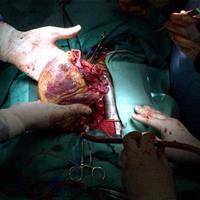 First Successful Dead Heart Tra...